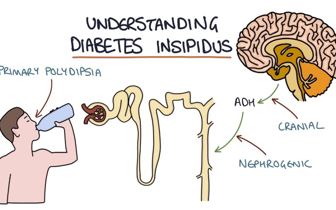 Understanding Diabetes Insipidus