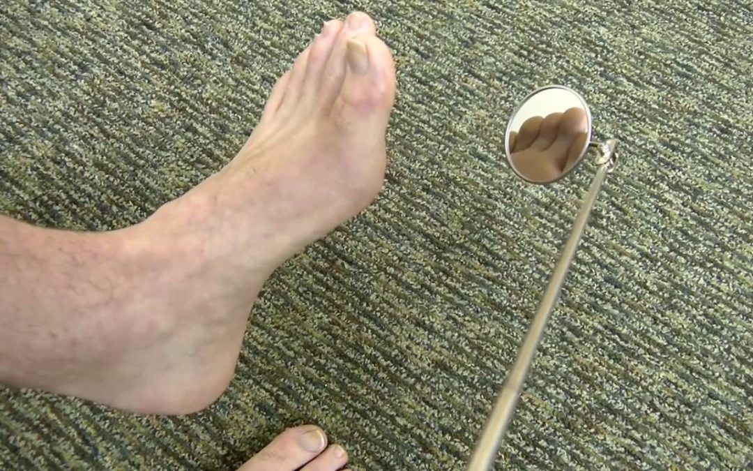 For People with Diabetes: How to Examine Your Feet