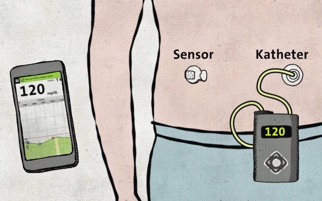 Diabetes Typ 1 – Moderne Technik ohne Zulassung – Gut zu wissen