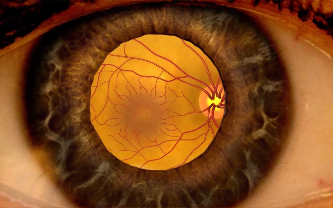 Animation: Detecting diabetic retinopathy through a dilated eye exam