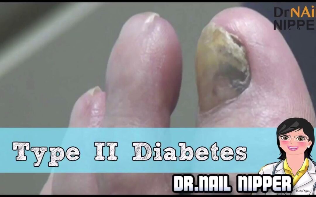 Type 2 Diabetes Foot Care Patient