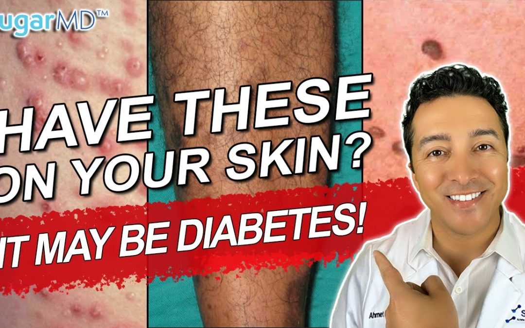 12 Diabetic Skin Problems & Top Signs of Diabetes on The Skin!