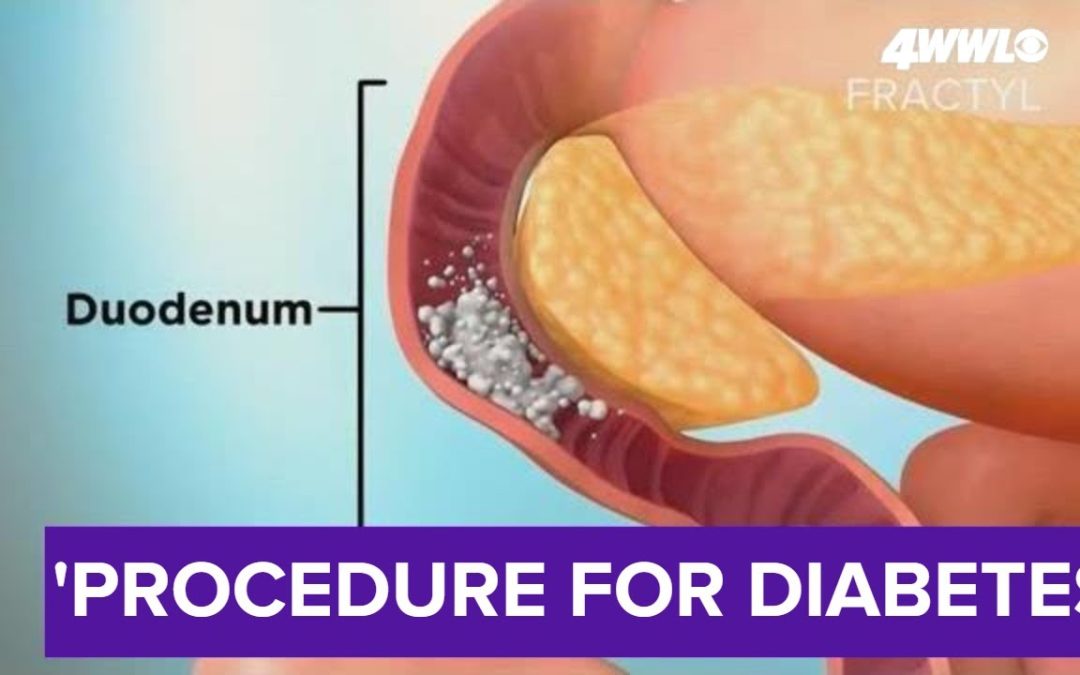 New study procedure for Type 2 diabetes