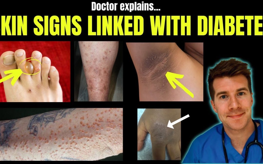 Doctor explains 12 SKIN CONDITIONS associated with DIABETES